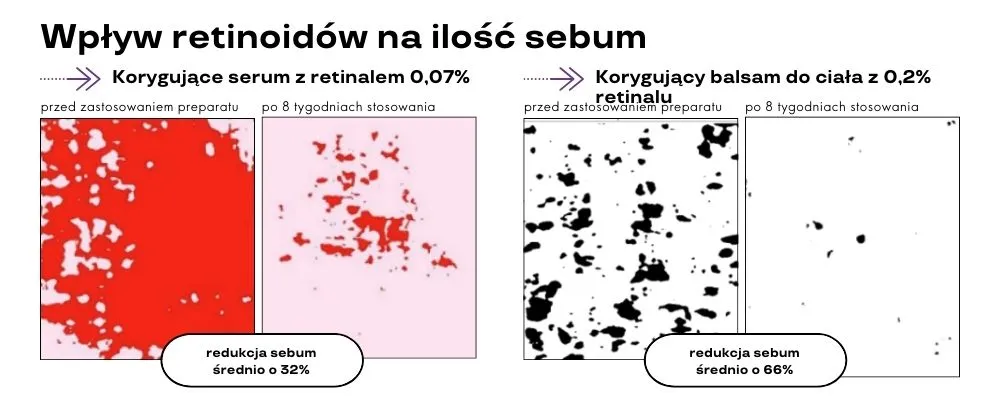 retinoidy na tłustą skórę