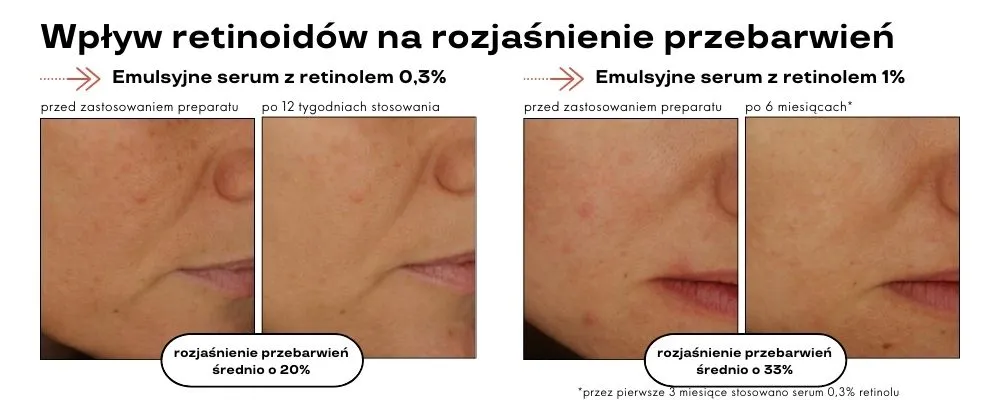 retinoidy na przebarwienia