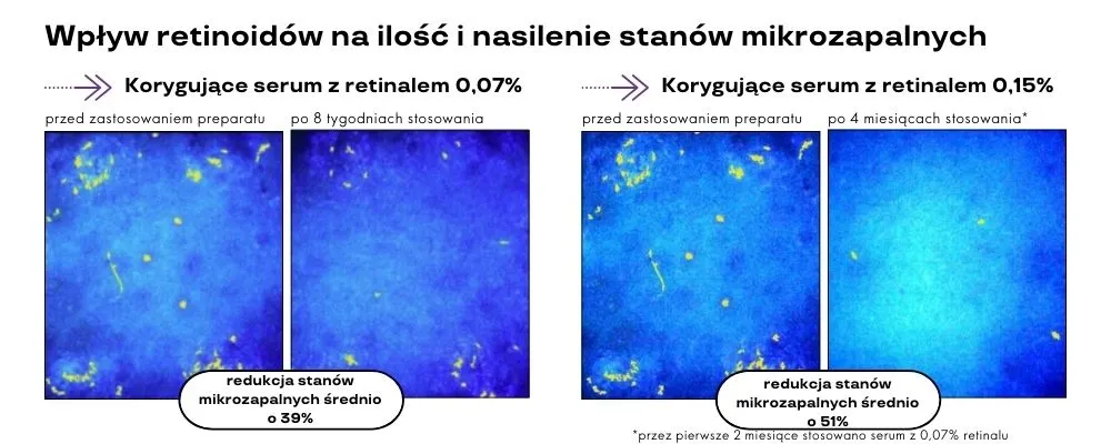 retinoidy na trądzik