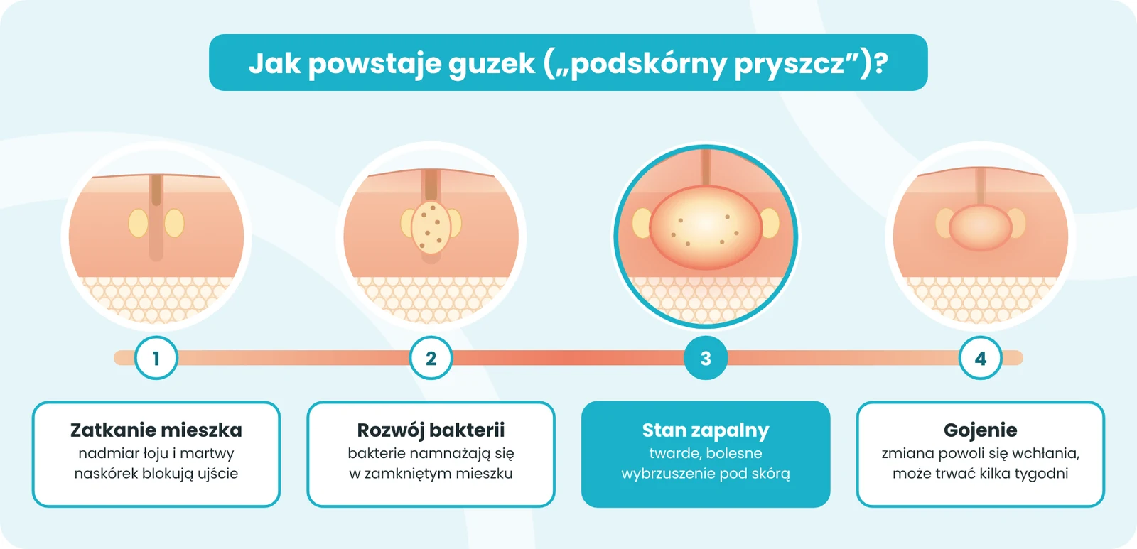 Etapy powstawania guzka („podskórnego pryszcza”)