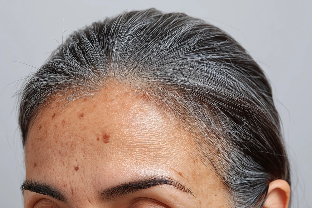 Plamy starcze pod lupą: przyczyny, prewencja i najskuteczniejsze kuracje