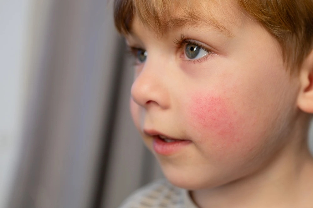 Atopowe zapalenie skóry – jak złagodzić objawy AZS?