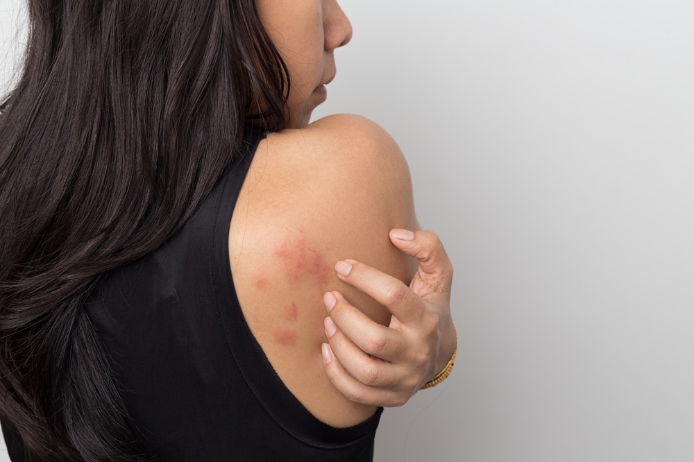 Pokrzywka alergiczna – przyczyny, objawy i sposoby leczenia